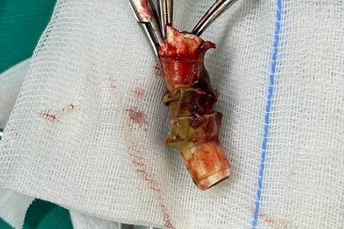 Cụ ông tắc hoàn toàn khí quản vì lười đi khám lại