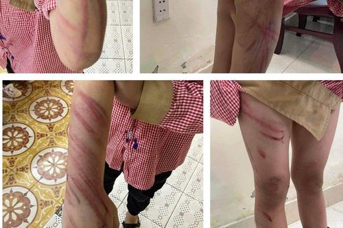 Bé 8 tuổi bị đánh tím tái toàn thân: Triệu tập người tình của mẹ