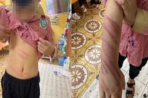 Bố dượng bạo hành con riêng của vợ khai 'bức xúc vì cháu nó hay trộm tiền'