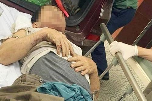 Nổ thùng phuy dầu, một giám đốc doanh nghiệp bị thương nặng