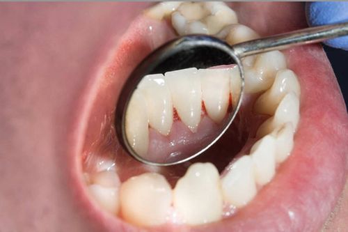 Chảy máu chân răng có thể là tín hiệu cảnh báo những căn bệnh nào?