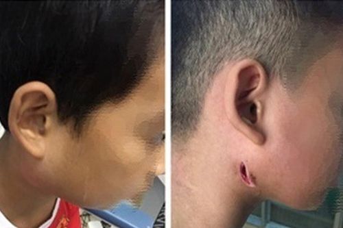 Đã có trường hợp tử vong vì bệnh Withmore, đối tượng nào nguy cơ cao nhất?