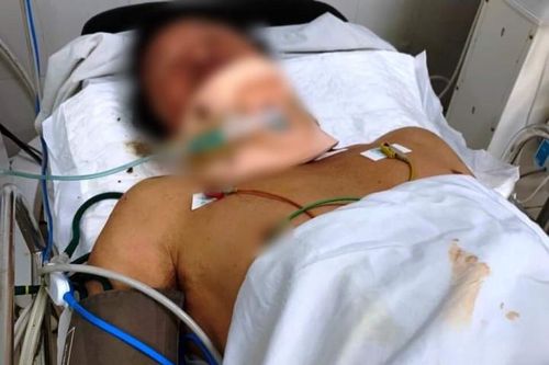 Người đàn ông bị tấm tôn chở trên xe ba gác cắt ngang cổ