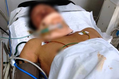 Va chạm với xe ba gác, người đàn ông ở Quảng Nam bị tôn cắt trúng cổ