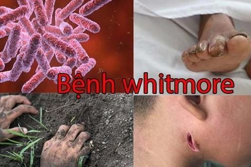 Đã có trường hợp tử vong vì Whitmore, cần biết về biểu hiện lâm sàng của bệnh