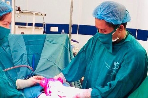 Vừa lấy thai vừa bóc tách 24 khối u xơ tử cung cho sản phụ