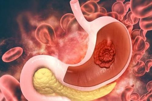 40 tuổi mắc ung thư dạ dày: Bác sĩ Bệnh viện K chỉ ra yếu tố khiến ung thư tới gần