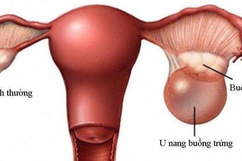 Chuyên gia cảnh báo phụ nữ mang thai không nên chủ quan với u buồng trứng
