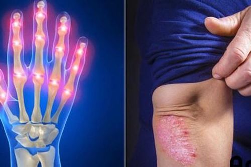 Ai dễ bị viêm khớp vẩy nến?