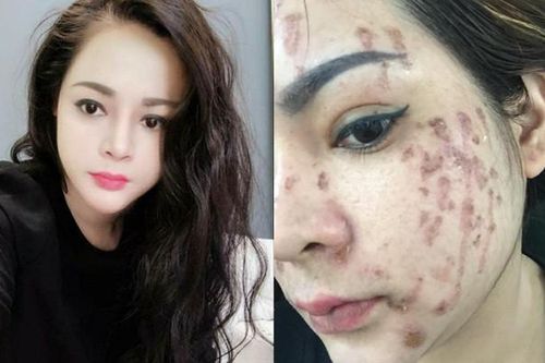 Cô gái trẻ cháy mặt vì nghe lời spa chấm nám