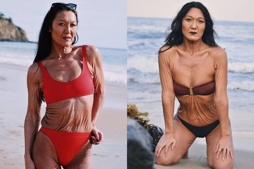 Mắc bệnh di truyền, người mẫu 31 tuổi có làn da nhăn nheo như bà lão