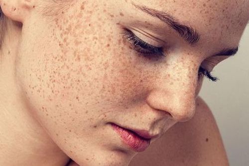 Lột da trị nám thần thánh và cảnh báo từ bác sĩ da liễu