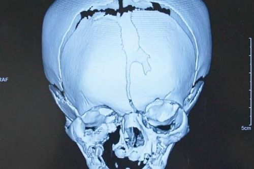 Bé trai 17 ngày tuổi có khe hở ở sọ gây biến dạng nửa mặt
