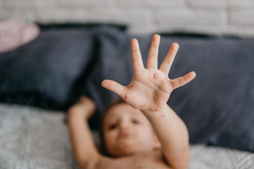 Ai không nên tiêm vaccine thủy đậu?