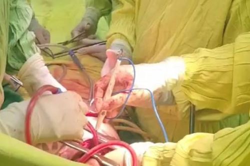 Cần Thơ: Cứu sống nam thanh niên bị dị vật đâm xuyên ngực, bụng