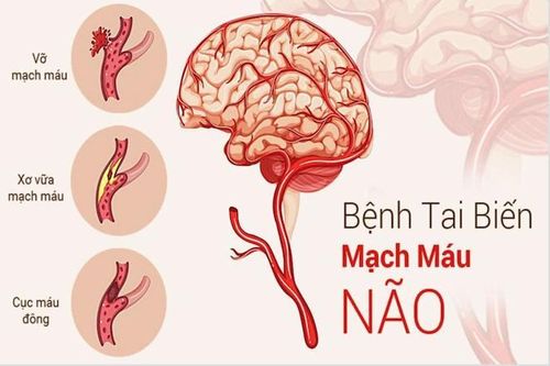 Cảnh báo nguy cơ tai biến mạch máu não ở người trẻ