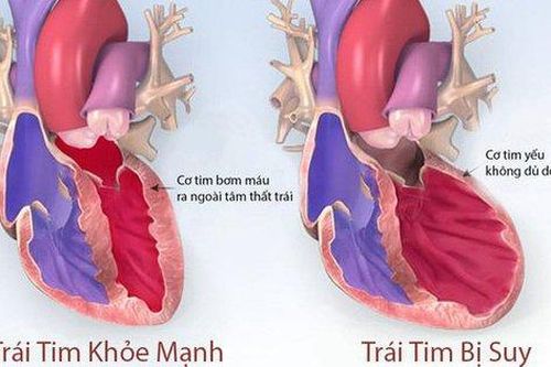 Thuốc giúp cải thiện triệu chứng ở bệnh nhân suy tim