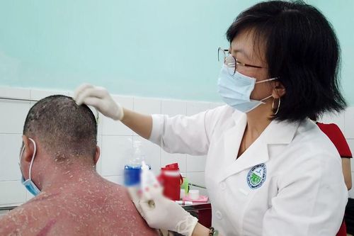 Nhiều ca nhập viện vì dùng thuốc chữa vảy nến trên mạng