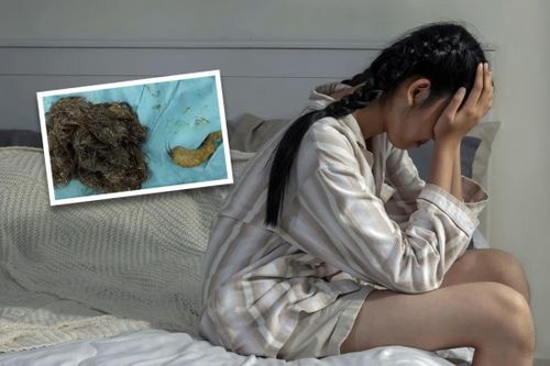 Hội chứng ăn tóc khiến cô bé 14 tuổi có 3 kg tóc trong bụng