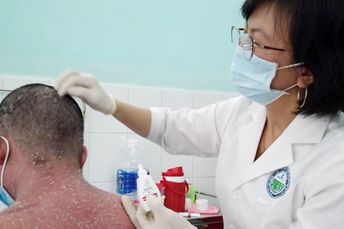 Nhiều trường hợp nhập viện do sử dụng thuốc chữa vảy nến trên mạng