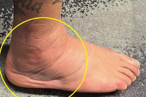 Mắt cá chân bất thường của Neymar
