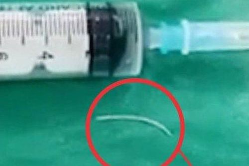 Xương cá găm vào lưỡi lúc ăn cơm, 20 ngày sau mới phát hiện nhiễm trùng