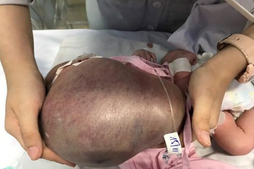 Bé sơ sinh 'gánh' khối bướu hạch bạch huyết khủng 1,1kg