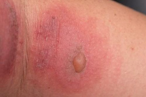 Đề phòng viêm da do tiếp xúc với côn trùng khi thời tiết chuyển mùa