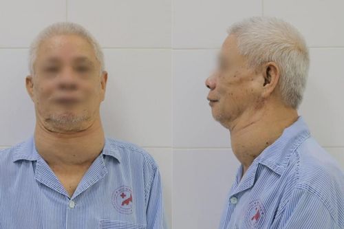 Cụ ông mang khối u gần bằng quả bưởi ở cổ được phẫu thuật thành công