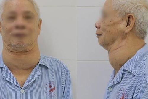 Phẫu thuật cho cụ ông mang khối bướu khổng lồ suốt nhiều năm