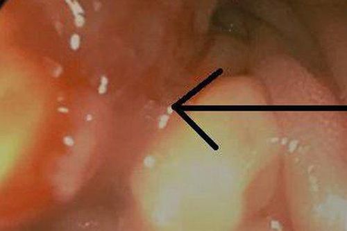 Bé trai 15 tuổi đã mắc ung thư đại tràng, làm gì để phòng tránh?