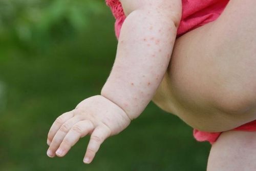 Triệu chứng và xử lý khi mắc sốt ban đỏ