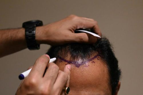 Cấy tóc gây chết chóc tại Ấn Độ