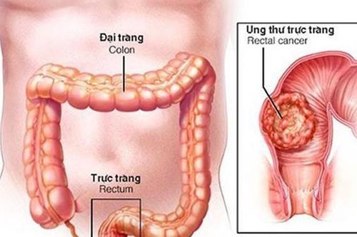 15 tuổi đã mắc ung thư đại tràng, cảnh báo bệnh ngày càng trẻ hóa
