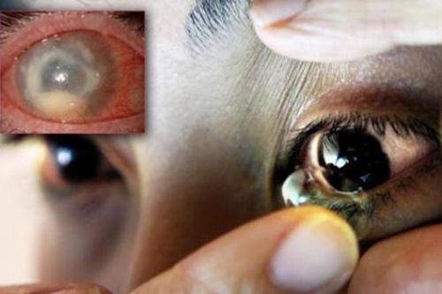 Sơ suất nhỏ khiến chú rể bị mù mắt sau đêm tân hôn