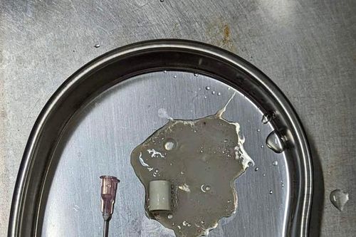 Nắp thuốc xịt họng rơi vào phế quản bệnh nhân