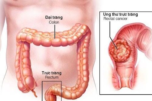 Mỗi năm, có khoảng 16.000 ca ung thư đại trực tràng mới