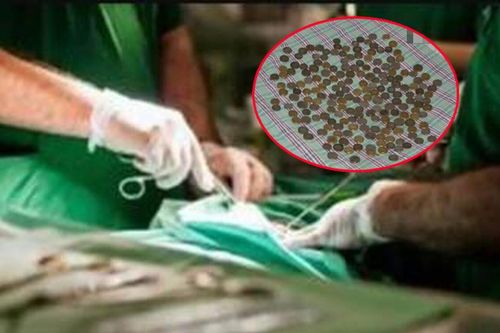 Bác sĩ chụp X-quang sốc nặng trước 'kho báu' trong bụng người đàn ông