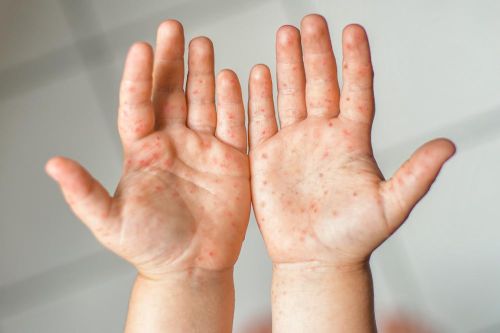 Con đường lây lan chính của virus tay chân miệng
