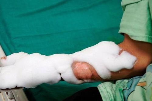 Thêm một thiếu niên bị điện thoại phát nổ khi vừa dùng vừa sạc gây tai nạn thương tâm