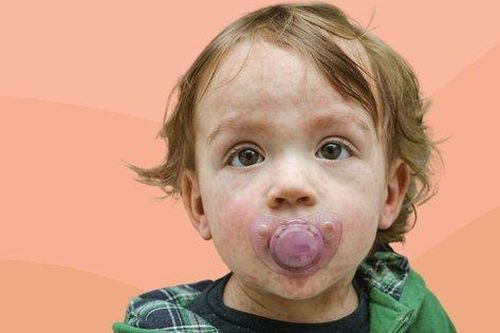 Nguy cơ bùng phát sởi do tỷ lệ tiêm phòng giảm
