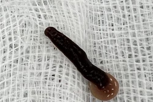 Gắp con đỉa dài 5cm ra khỏi mũi bệnh nhân