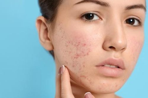 Thuốc kháng sinh trị mụn trứng cá có thể ảnh hưởng đến xương ở thanh thiếu niên