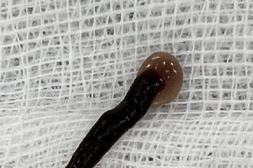 Gắp con đỉa dài 5cm sống trong mũi bệnh nhân