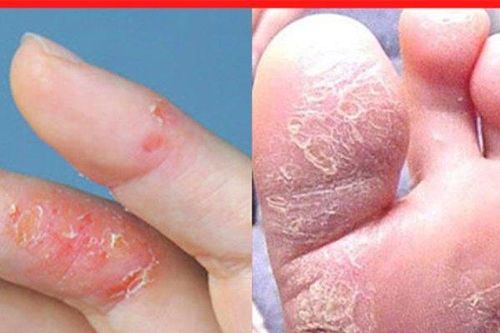 Khổ sở vì tay chân ngứa ngáy, nứt nẻ, bong tróc thành từng mảng - Ở đây có giải pháp!