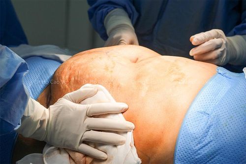 Phẫu thuật tạo hình thành bụng kết hợp điều trị bệnh lý thoát vị thành bụng