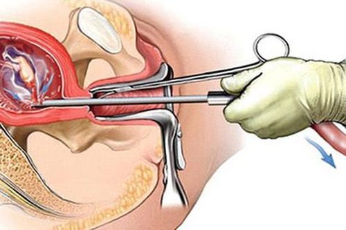 Bác sĩ sốc khi nghe bệnh nhân nói 'đã nạo hút thai 18 lần'