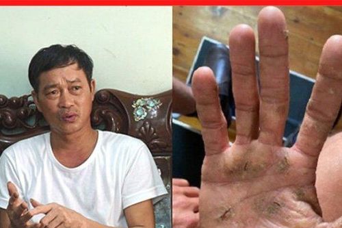 Tuyệt vọng vì viêm da ngứa gãi 'xoành xoạch', xem ngay mẹo này kẻo tiếc!