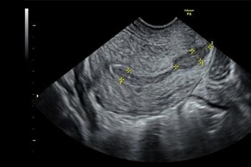 Khuyết sẹo mổ lấy thai điều trị thế nào?