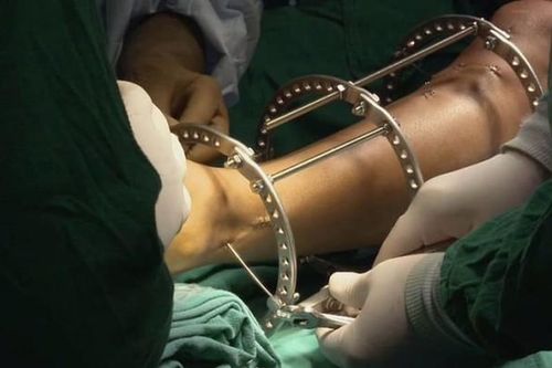 Ham kéo dài chân, cô gái 19 tuổi không thể đi lại được